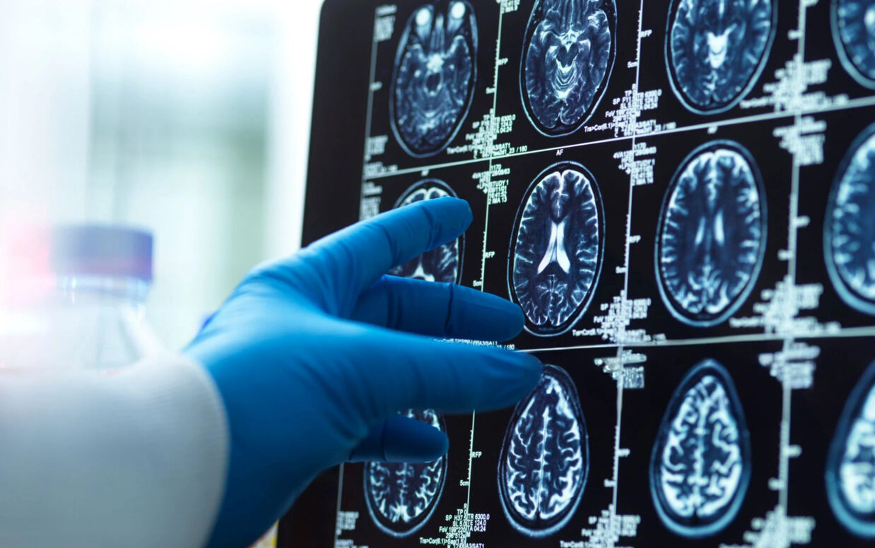 A doctor's hand in a surgical glove pointing at a brain scan image